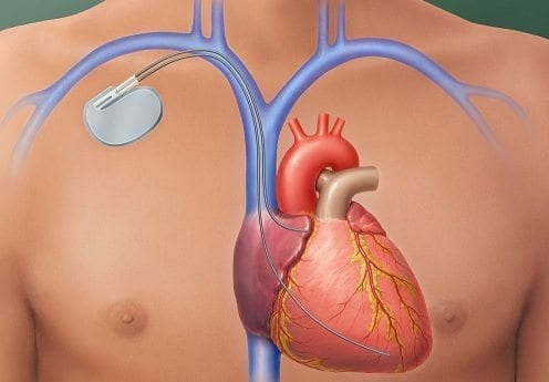 medicamento y un marcapasos combaten la arritmia cardiaca