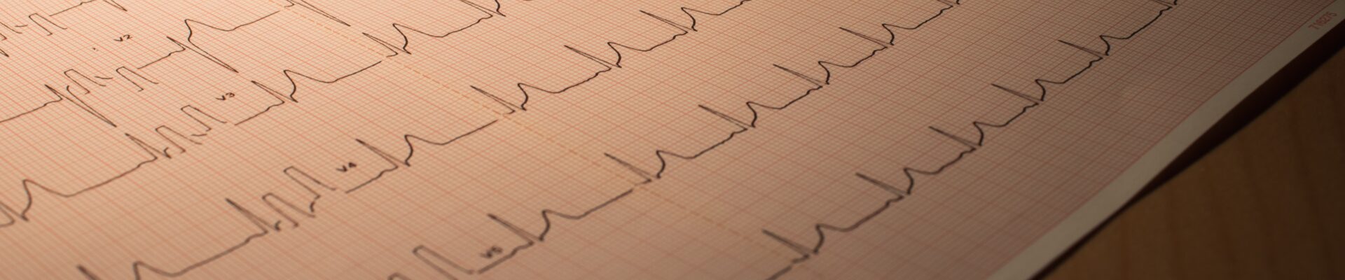 Un corazón acelerado Se considera que tiene una frecuencia cardíaca rápida o taquicardia, con más de 100 latidos por minuto estando en reposo.