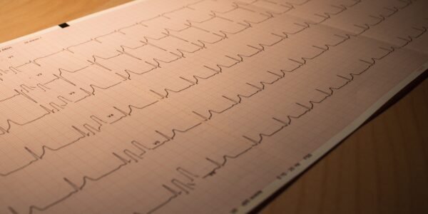 Un corazón acelerado Se considera que tiene una frecuencia cardíaca rápida o taquicardia, con más de 100 latidos por minuto estando en reposo.
