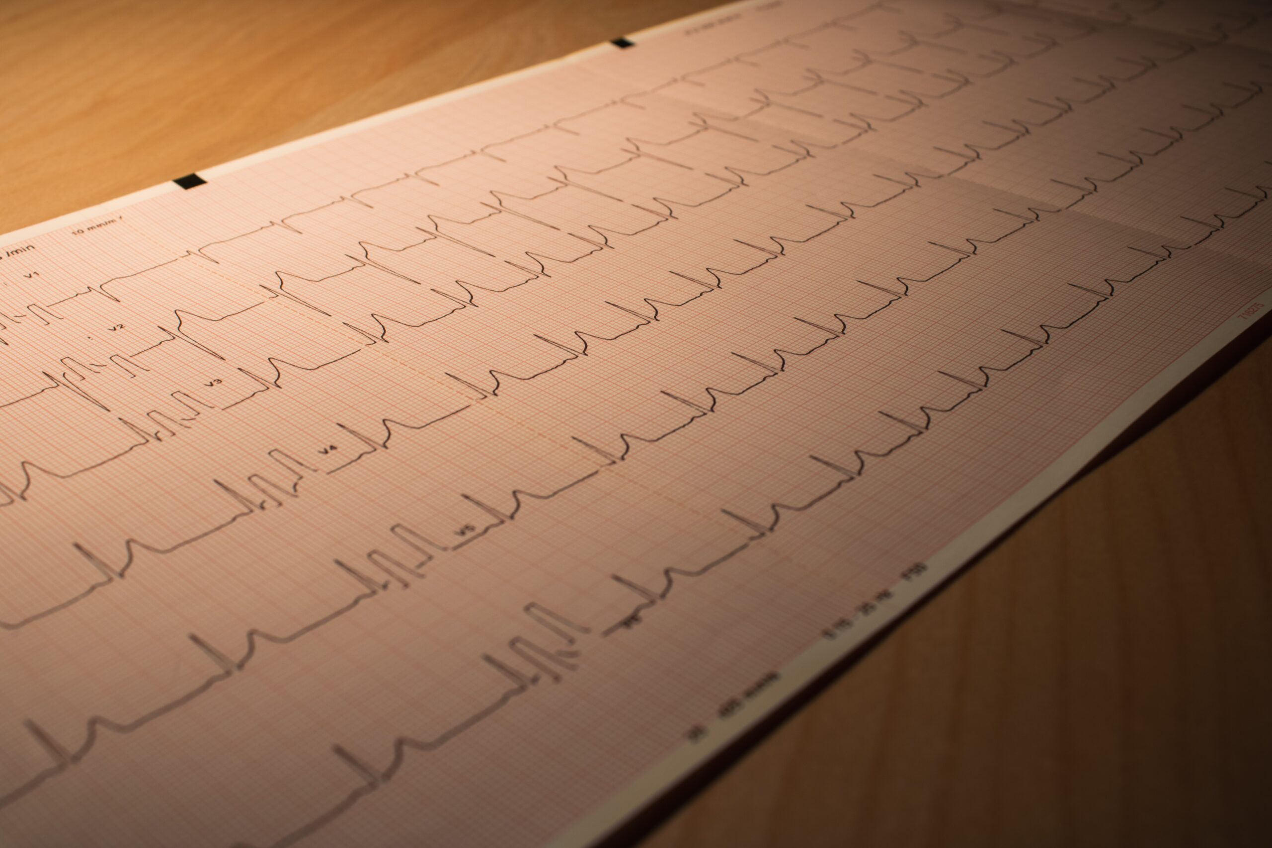 Un corazón acelerado Se considera que tiene una frecuencia cardíaca rápida o taquicardia, con más de 100 latidos por minuto estando en reposo.